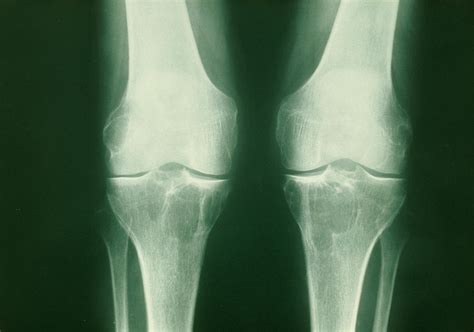 X Ray Of Knees With Bakers Cysts Photograph By Medical Photo Nhs Lothianscience Photo Library