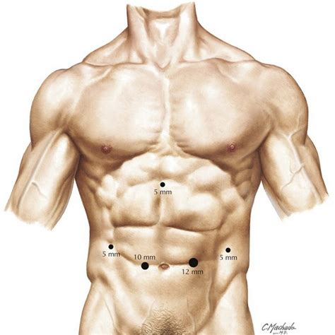 Distal Pancreatectomy | Basicmedical Key