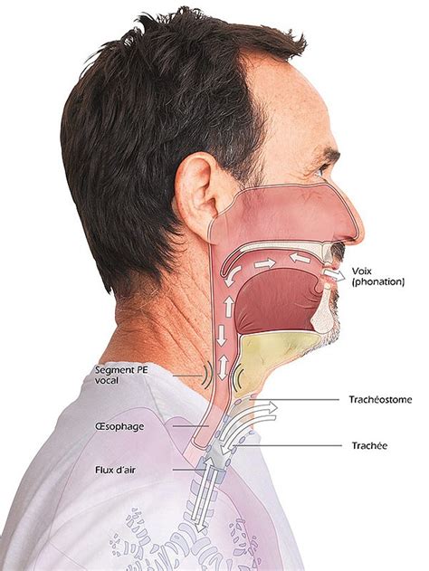 Cancer Du Larynx Et Laryngectomie Fahl