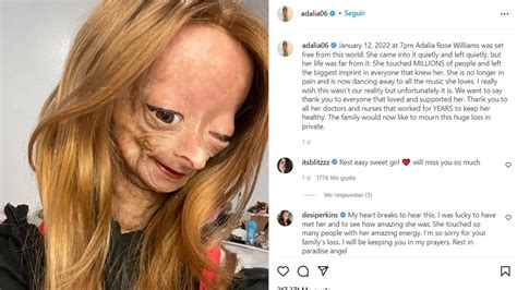 Muere Adalia Rose La Joven Youtuber Que Padecía La Enfermedad De