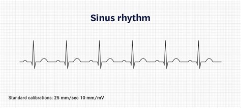 How To Calculate Heart Rate From Ecg Or Ekg Seer Medical