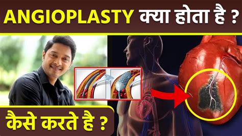 Angioplasty Surgery Kya Hai Angioplasty Surgery Kaise Hota Hai