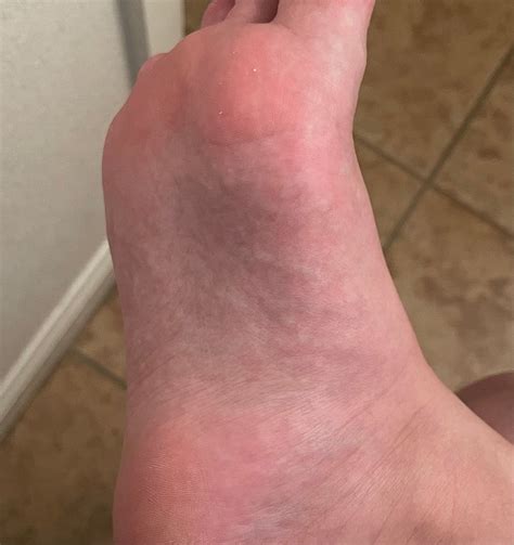 Tiny Bumps On Bottom Of Foot Online Emergencydentistry