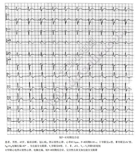 短pr间期综合征（lgl症状、james型预激综合征） 心血管 天山医学院