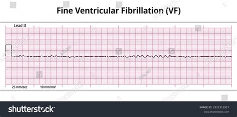 Coarse Ventricular Fibrillation Rhythm Strip