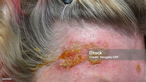 Skin Cancer Treatment Stock Photo - Download Image Now - Adult, Adults ...