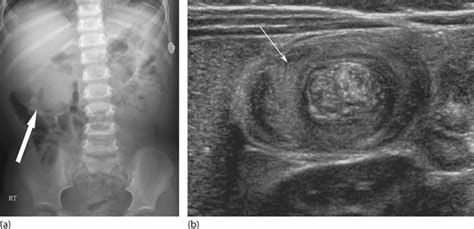 Target Sign Intussusception X Ray / The appearance is generated by ...