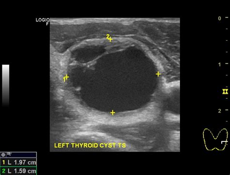 Thyroid Cysts Dr Jeeve Ent Specialist