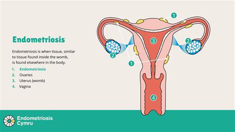 What is endometriosis? - Endo Cymru