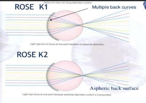 Contact Lens Fitting In Keratoconus Optography