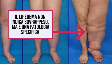 La Nuova Tecnica Non Invasiva Per Contrastare Le Gambe Gonfie