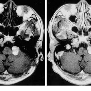 T Weighted Magnetic Resonance Images With Contrast Enhancement