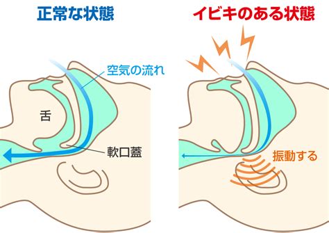 耳鼻科医が『いびき』の危険性と対処法について解説します