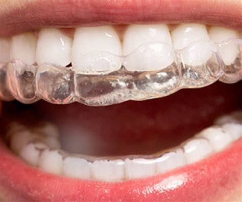 Invisalign vs. Traditional Braces - What's the Right Choice for You