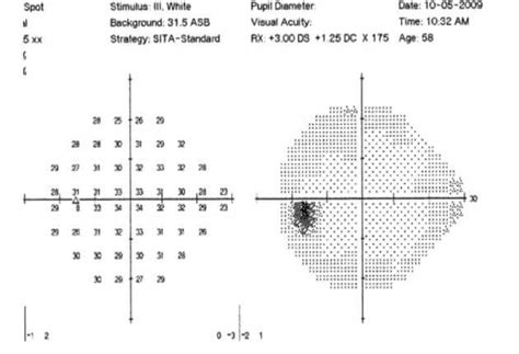 Visual Field Normal Wills Eye Hospital