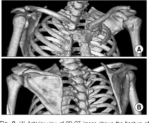 Figure 1 From Concomitant Fracture Of The Coracoid Process And The Acromion A Case Report