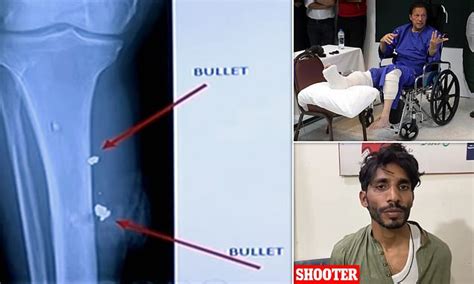 Imran Khan Reveals X Rays Of His Legs With Bullets Still Inside His Limbs