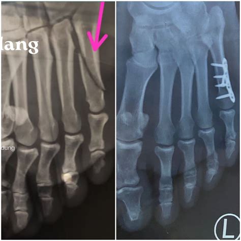 Operasi Patah Kaki Akwnulis