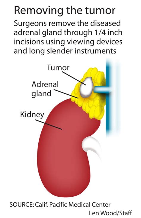 Adrenal Gland Tumor