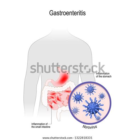 Gastroenteritis Viral Disease That Caused By Stock Vector Royalty Free 1322818331 Shutterstock