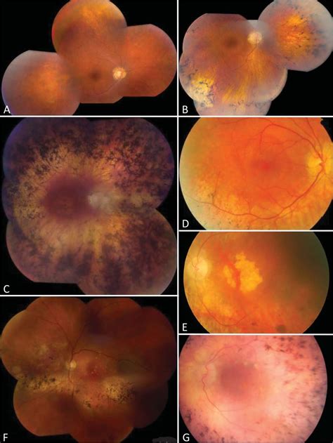 Color Fundus Photography In This Cohort Of Rhoassociated Rp A C