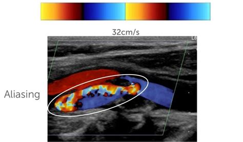 3 Instrumentation And Physical Principles Of Carotid Duplex Ultrasound 123 Sonography