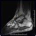 Anterior ankle impingement-MRI - Sumer's Radiology Blog