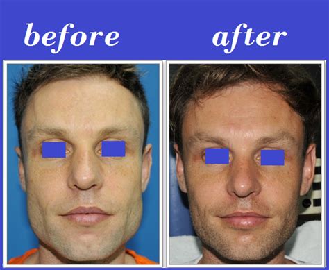 Jaw Reduction By Botox Before And After Photos Artofit