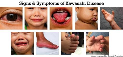 Dark Skin in 10 Fingers of 2 Months Baby Is Heart Disease - Henry Ligh1993