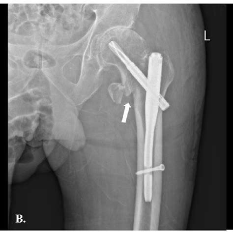 A The Preoperative Anteroposterior Ap Radiograph Showing An Download Scientific Diagram