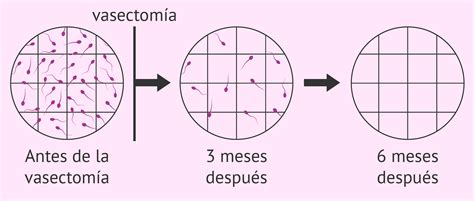 ¿qué Es El Seminograma De Control Después De La Vasectomía