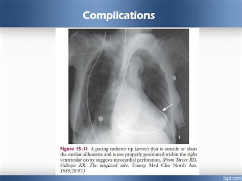 PPT - Emergency Cardiac Pacing PowerPoint Presentation, free download ...