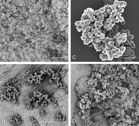 Frontiers Enterococcal Endocarditis Hiding In Plain Sight