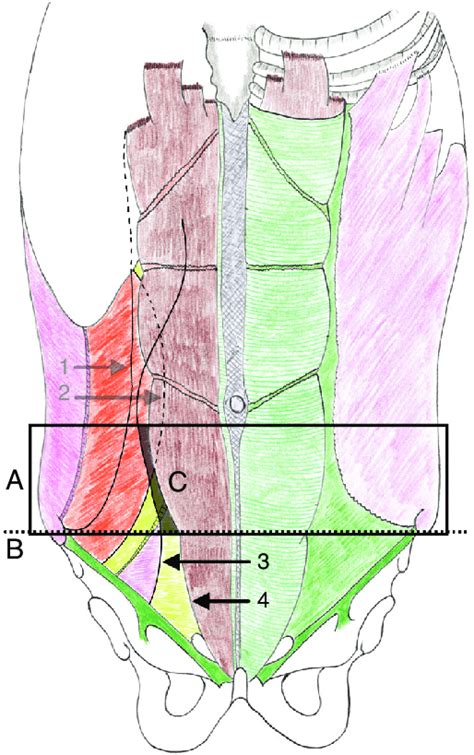 Linea Semilunaris Hernia