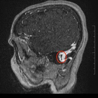 MR venography showing left sigmoid sinus chronic thrombosis. | Download ...