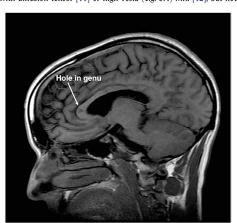 Figure From Susac S Syndrome Update Semantic Scholar