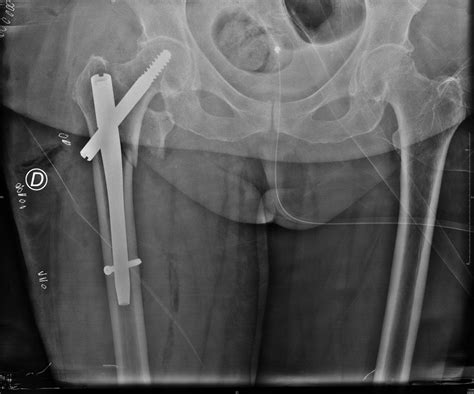 Fracture Du Massif Trochanterien Intervention Sur Les Traumatologies