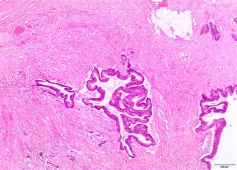 Pathology Outlines Metastases