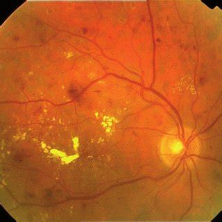 PDF Diabetic Macular Edema