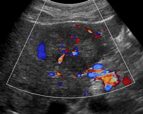 Liver Atlas Diagnosis Focal Nodular Hyperplasia Fnh