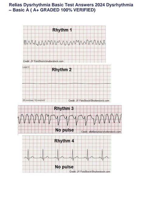 Solution Relias Dysrhythmia Basic Test Answers Dysrhythmia Basic