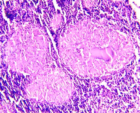 B Granuloma Composed Of Epithelioid Cells Lymphocytes And Download Scientific Diagram