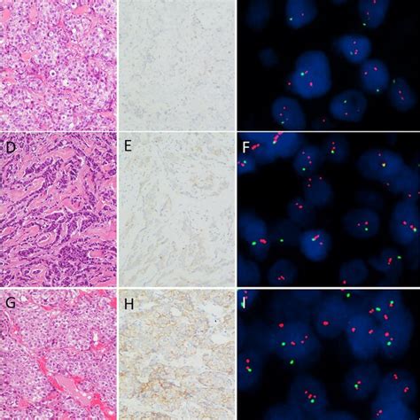 Example Of Invasive Carcinoma Of No Special Type With Her2 Download Scientific Diagram