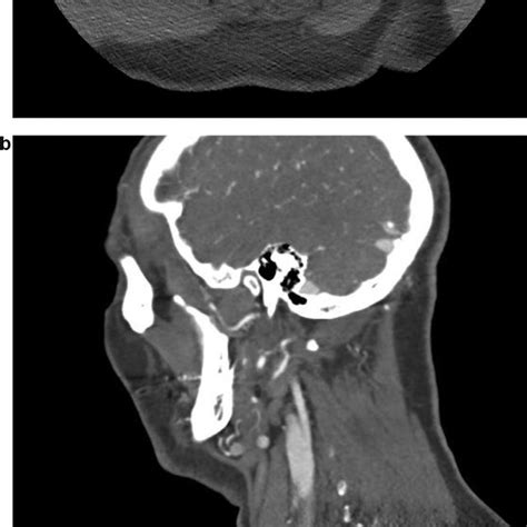 A Axial Ct Angiogram Obtained At The Time Of The Patient S First