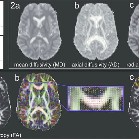 Diffusion Tensor Imaging The Diffusion Tensor Model Showing