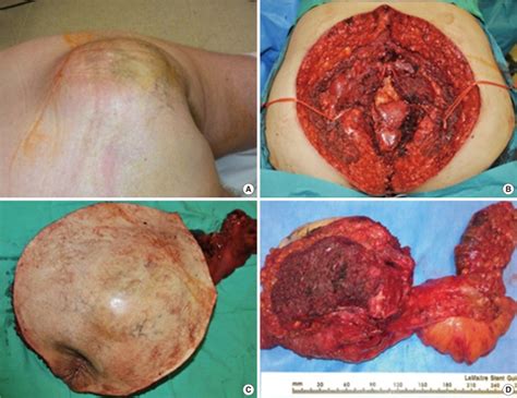 A Clinical Presentation Of The Sacral Chordoma In Patient B