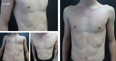 Vacuum Bell Therapy Vbt And Rib Flare Bracing For Pectus Excavatum