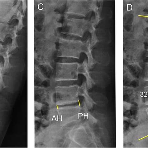 Measurement Of Lumbar Multifidus Muscle Cross Sectional Area Mf Csa