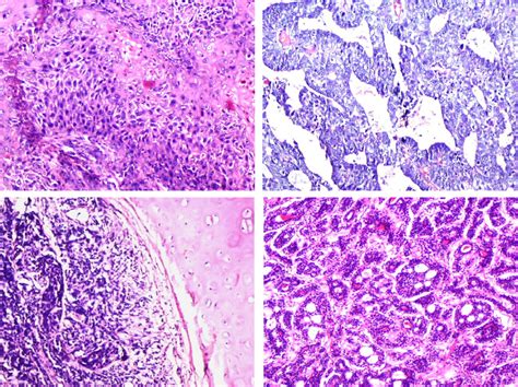 Photomicrographs Showing Well Differentiated Squamous Cell Carcinoma Download Scientific