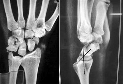 Preoperative Radiograph Showing Fracture Of The Scaphoid Capitate And